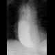 Achalasia of oesophagus: RF - Fluoroscopy